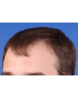 Before Hair Transplant&nbsp;Hairlines